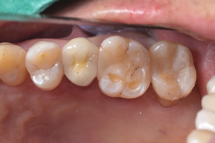 부천 인접면 충치 치료, 러버댐과 바이오미메틱으로 자연치아 살리는 법 | 상동 온아치과