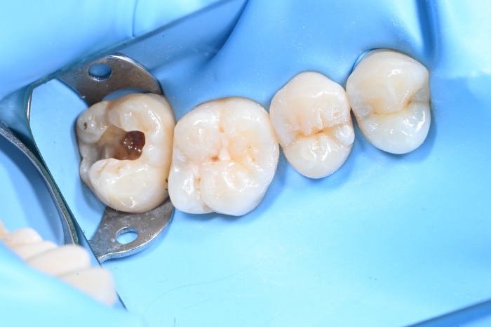 부천 충치 치료 잘하는 치과, 신경치료 없이 레진으로 살린 큰 충치 사례 | 상동 온아치과