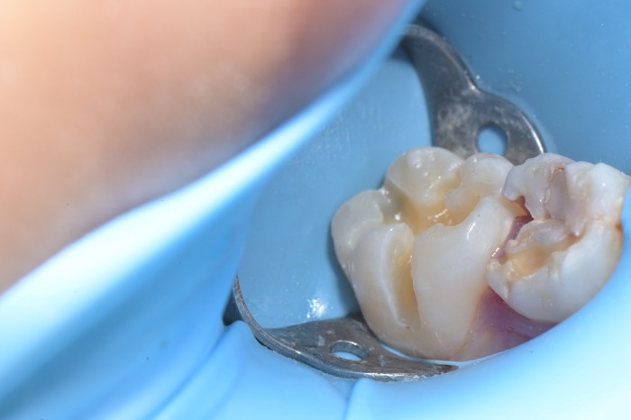 부천 소아 충치 치료, 아이 어금니 레진 “형태”까지 제대로 해야 하는 이유 | 상동 온아치과